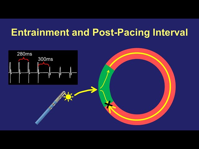 Entrainment Mapping: The Post-Pacing Interval