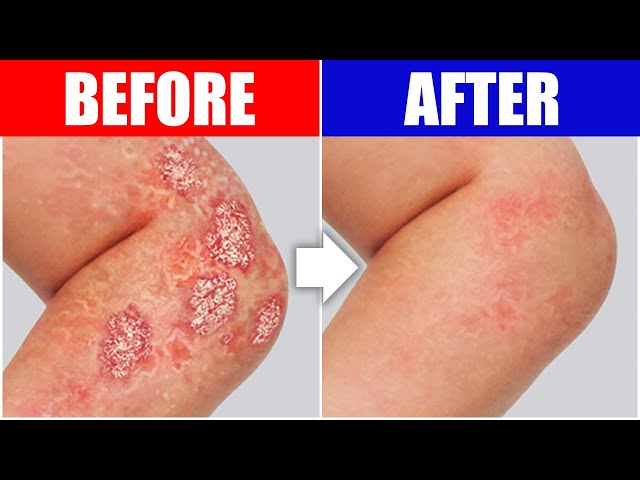 Psoriasis Relief: The Best Remedy For Your Skin