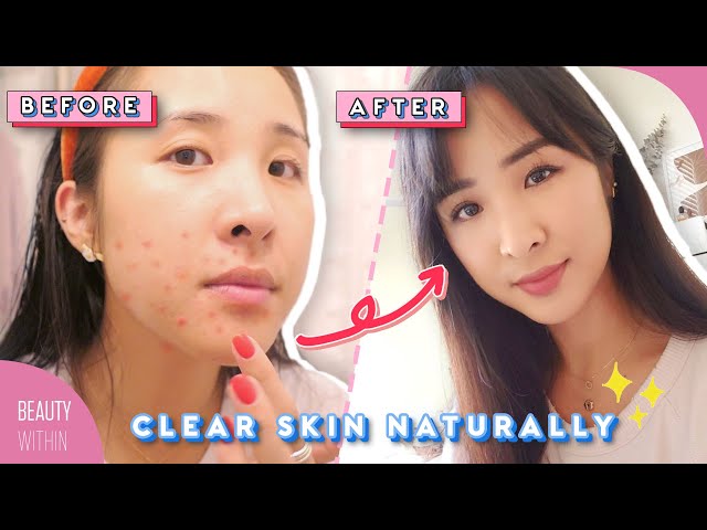 💢Top 3 Foods to AVOID for Clear Skin 💢 Treat Acne & Breakouts Naturally! 🌱