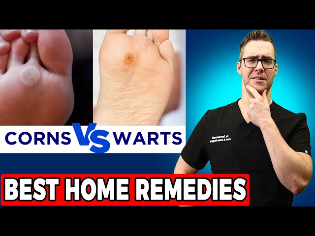 Plantar Warts vs Corns vs Calluses [TOP 20 BEST Home Remedies]