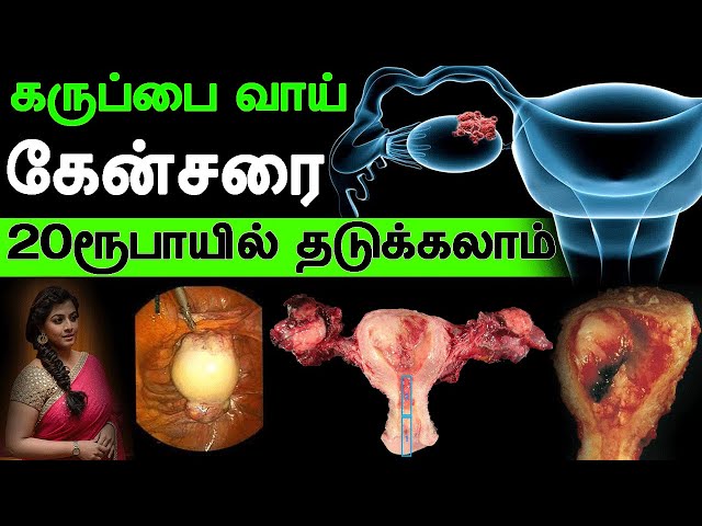இத வச்சு uterus கேன்சர் வராமல் தடுக்கலாம் | Iyarkai murai | Karppapai | Utres Problems in tami