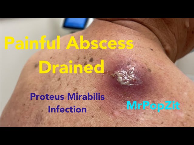 Painful large abscess infected with Proteus Mirabilis drained.Cyst contents start at 14:10. Amazing!