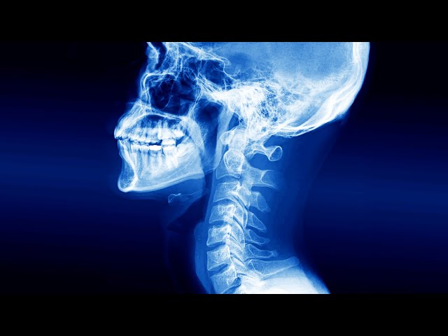 A Man Swallowed Wireless Earbud. This Is What Happened To His Esophagus.