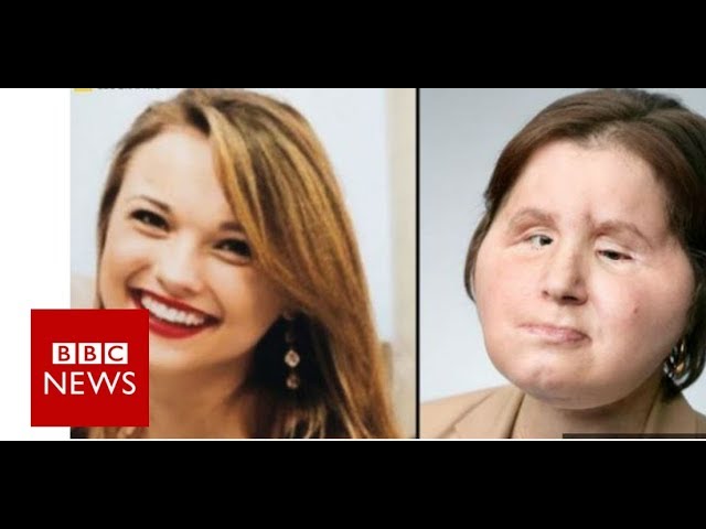 Coping with our daughter's new face - BBC News