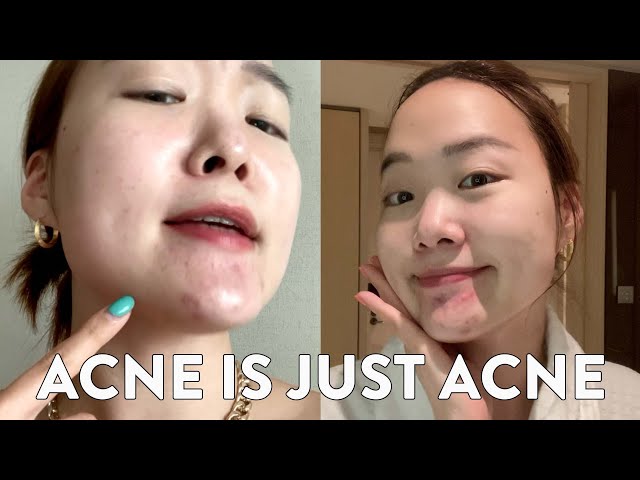 Acne is just a acne. Hope this helps you care a little less about your acne❤️