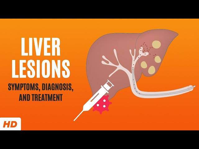 Liver Lesions: Symptoms, Diagnosis and Treatment