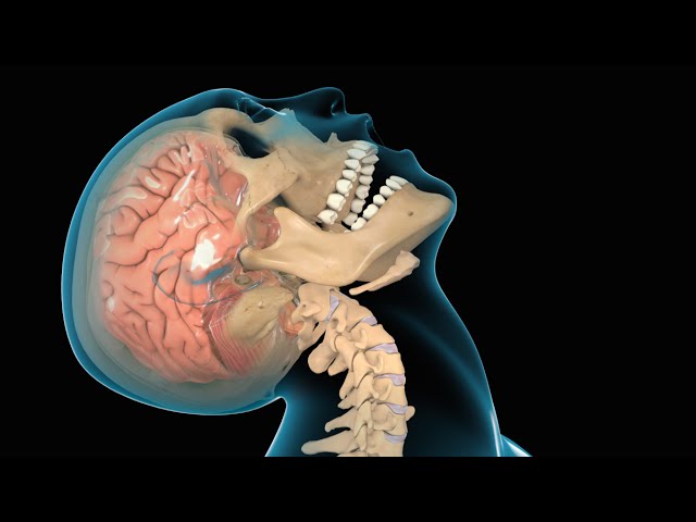 Concussion / Traumatic Brain Injury (TBI)
