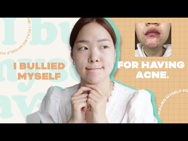 I bullied myself for having acne