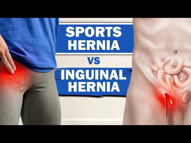 Sports Hernia Vs Inguinal Hernia - Symptoms And The Differences?