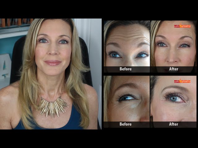 Botox Results Mature Skin | Crows Feet & Forehead Wrinkles