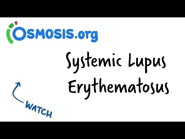Systemic Lupus Erythematosus | Clinical Presentation