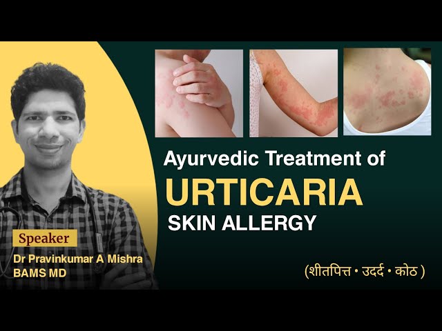 Allergic Skin Diseases treatment in Ayurved - Dr Pravinkumar A Mishra #ayurved #skin #allergy