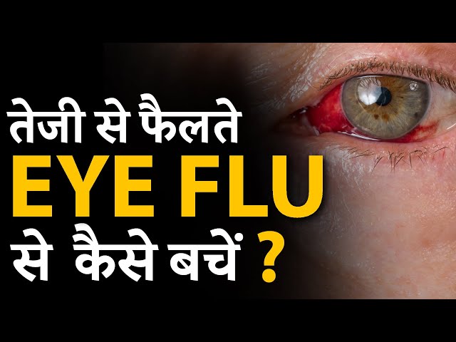 कैसे बचें आँखों की एलर्जी (आँख आना)) से? - Conjunctivitis (Eye Infection) Prevention and Treatment