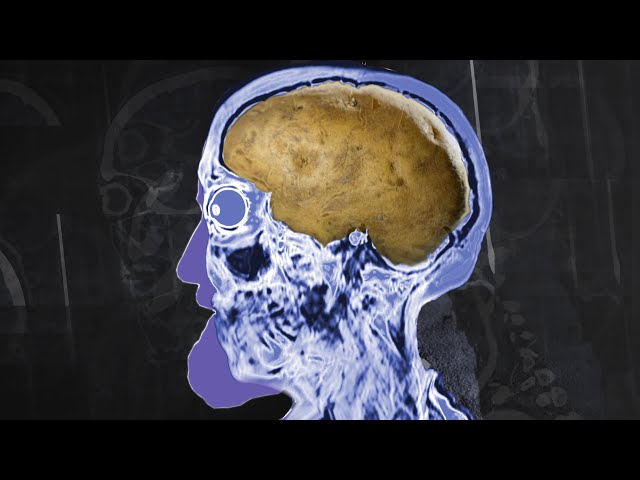 A Man Had 2 Week Old Baked Potato For Dinner. This Is What Happened To His Brain.