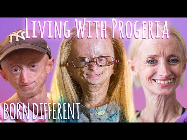 Living With Progeria (30 Min Documentary) | BORN DIFFERENT