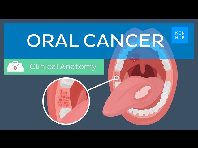 Oral cancer: Epidemiology, risk factors, prevention, symptoms and treatment | Kenhub