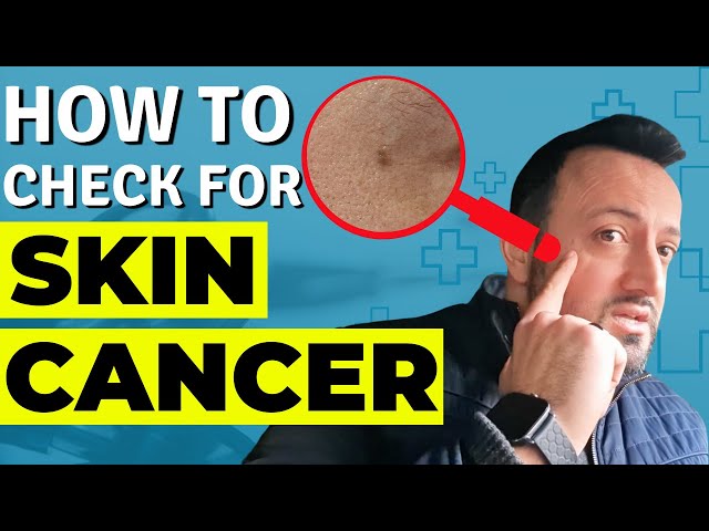 How To Check For Skin Cancer