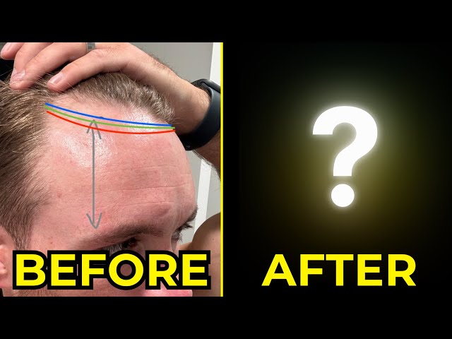 My Decision to Get Hair Transplant Surgery. The 'Before' Video