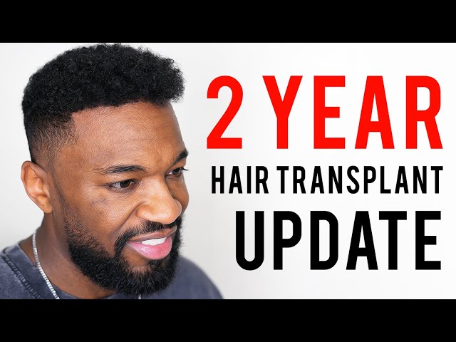 2 Year Hair Transplant Update & New Hair Journey with Copenhagen Grooming!