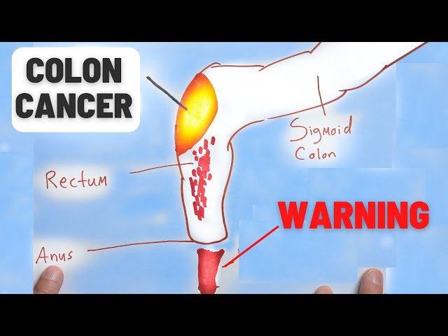 4 Warning Signs of Colon Cancer You Should NEVER Ignore