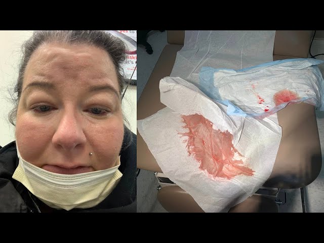 BARTHOLIN’S CYST REMOVAL & RECOVERY - MOST PAIN EVER (part 1)