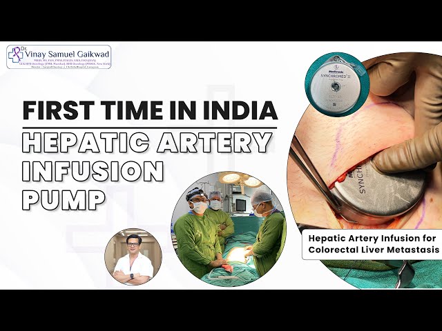 First Time in INDIA - Hepatic Artery Infusion for Colorectal Liver - Dr. Vinay Samuel Gaikwad & Team