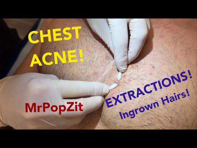 Chest congestion-blackheads, whiteheads, ingrown hairs. Multiple plugs extracted, patient left happy