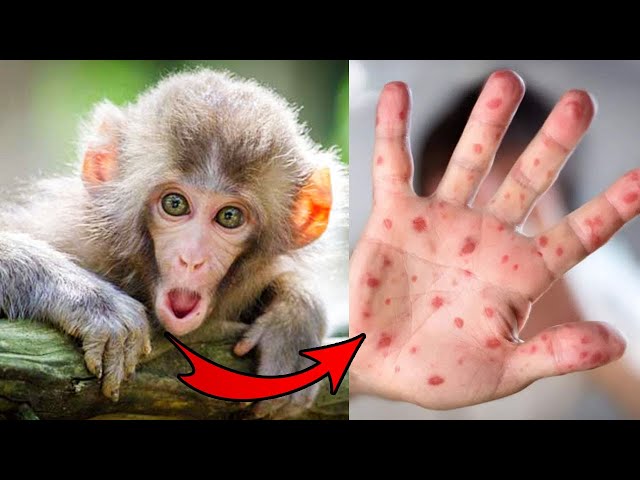 Is Monkeypox The Next Pandemic?