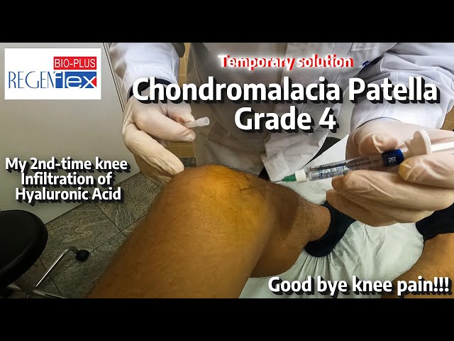 Second Knee Injection | Chondromalacia Patella Grade 4 | Regenflex BIO-PLUS