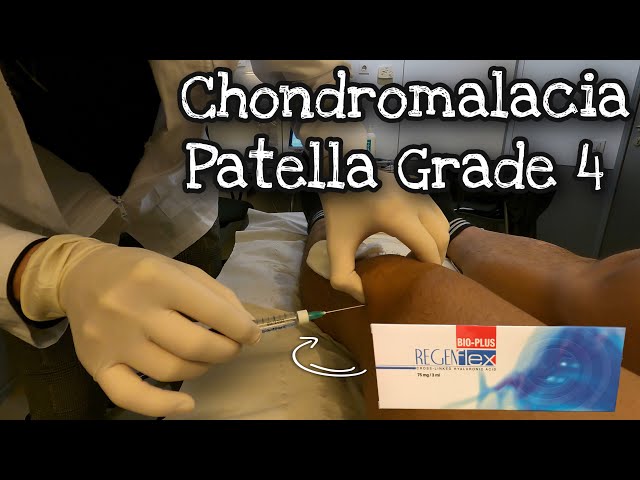Knee Injection | Chondromalacia Patella Grade 4 | Regenflex BIO-PLUS