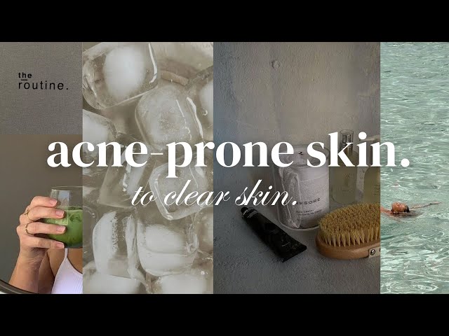How I cleared my acne prone skin ♡ morning & nighttime skincare routine