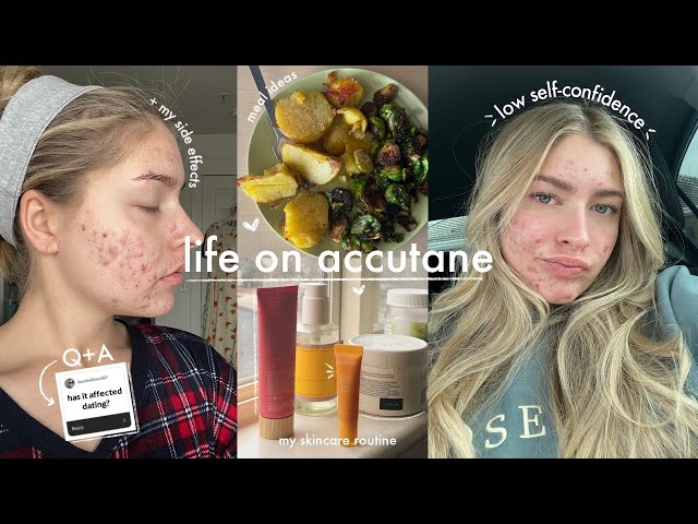 my accutane experience (side effects, self confidence, etc!)