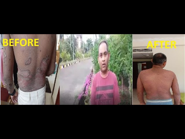 Psoriasis Treatment Testimonial of a Patient in India | Ayurveda Treatments in Kerala, India