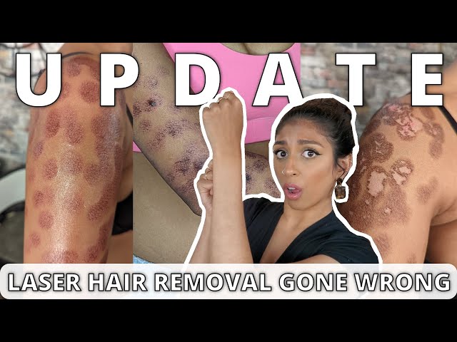 Laser Hair Removal Burn 6 Month Update | Eshi Jay