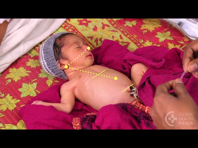 Inserting a Nasogastric Tube (Persian) - Small Baby Series
