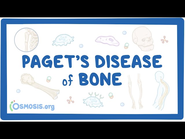 Paget disease of bone