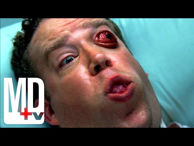 Patient's Eye Bursts Out of Head | House M.D. | MD TV