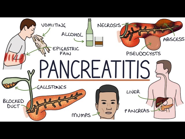 Understanding Pancreatitis
