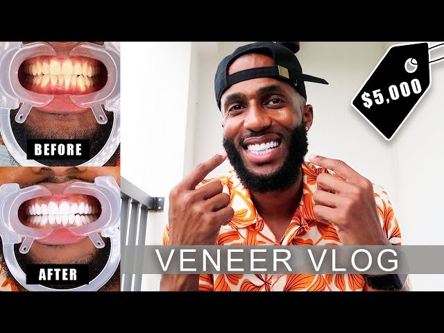 MY $5,000 SMILE TRANSFORMATION! | COMPOSITE-RESIN VENEERS | Vlog #37