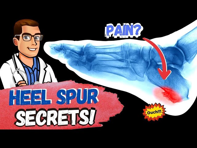 BEST Heel Spur Treatment [Heel Spur Removal, Stretches & Massage!]