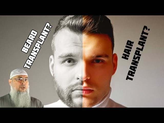 Ruling on Beard Transplant & Hair Transplant in Islam - Assim al hakeem
