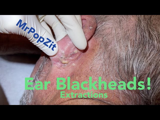 Ear Blackhead extractions. Multiple techniques used for deep embedded dry plugs and cyst pops.
