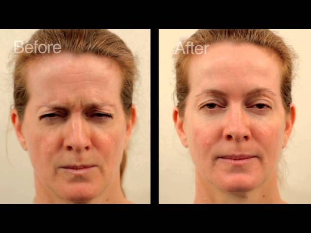 Animated before and after anti-wrinkle injections