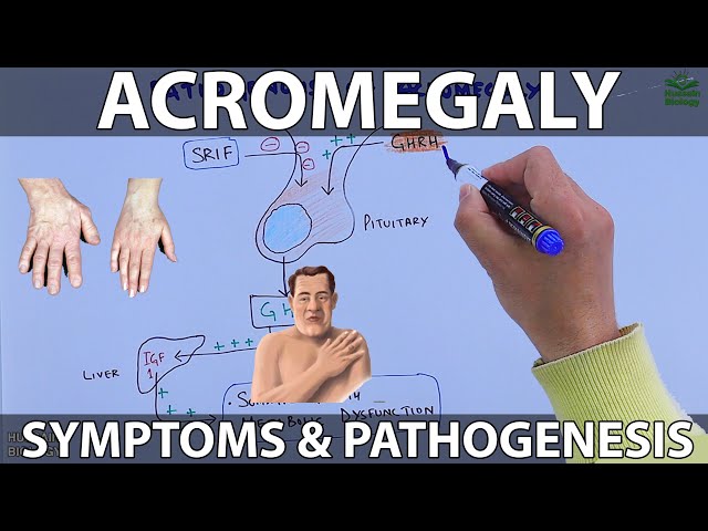 Acromegaly | Symptoms and Complications