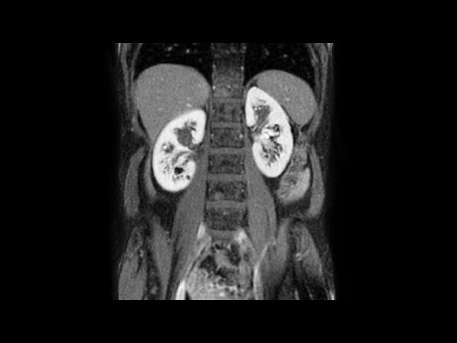A Diabetic Mom Caught A Fever. This Is How Her Kidneys Shut Down.
