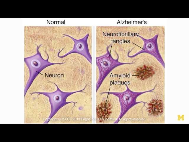 Mining the Causes of Alzheimer's