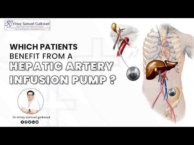 Which patients Benefit from a Hepatic Artery Infusion (HAI) Pump? | Dr. Vinay Samuel Gaikwad #cancer