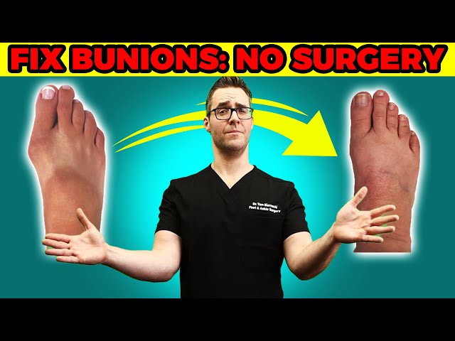 Bunion Home Cure [WOW] Stretches, Exercises & Correctors *NO Surgery*