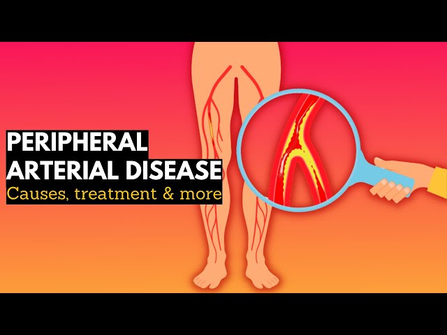 Peripheral vascular disease, Causes, Signs and Symptoms, Diagnosis and Treatment.