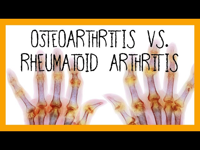 Osteoarthritis vs. Rheumatoid Arthritis